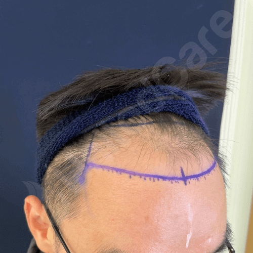 unitedcare clinic hair transplant patient before surgery