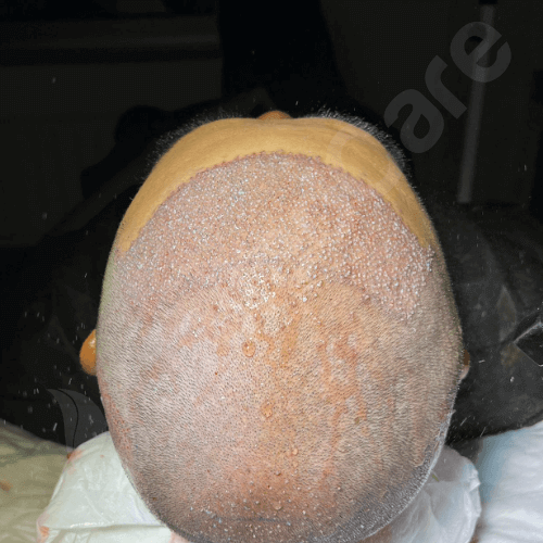 Пациент клиники unitedcare по пересадке волос сразу после операции по пересадке 3470 графтов