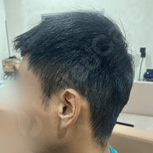 unitedcare clinic hair transplant patient post-op 6-month