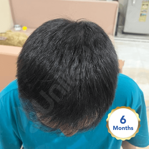 пациент клиники unitedcare после операции по пересадке волос через 6 месяцев