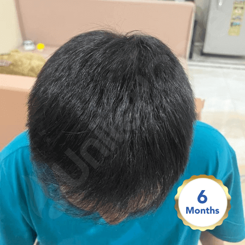 unitedcare clinic hair transplant patient post-op 6-month