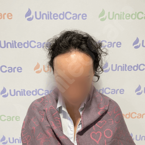 Пациентка клиники unitedcare перед операцией по случаю пересадки волос для женщин