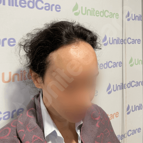 unitedcare clinic female hair transplant patient pre-op side angle