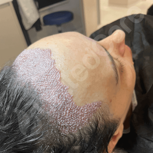 unitedcare clinic dhi hair transplant patient right after 2830 graft surgery