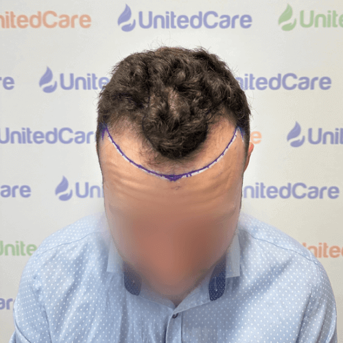 unitedcare clinic Haartransplantationspatient vor der Operation Haaransatz gezeichnet