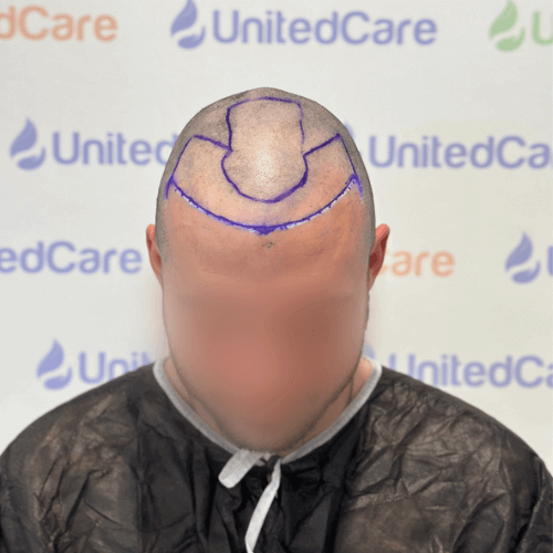 unitedcare clinic hair transplant patient hair shaven