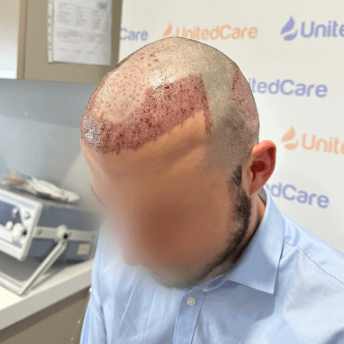 Пациент с пересадкой волос по методу FUE в клинике unitedcare сразу после операции по пересадке 2550 графтов