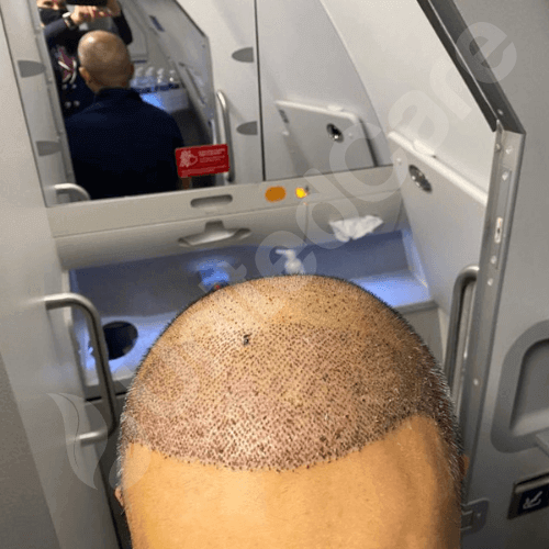 unitedcare clinic hair transplant patient post-op 3rd day