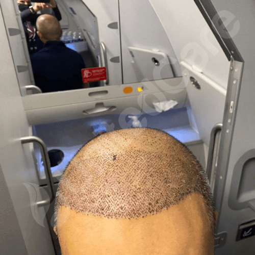 unitedcare hair transplant before after