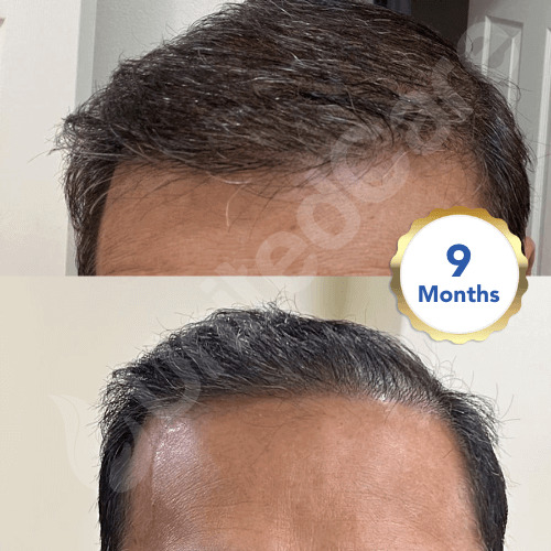 пациент после операции по пересадке волос в клинике unitedcare через 9 месяцев