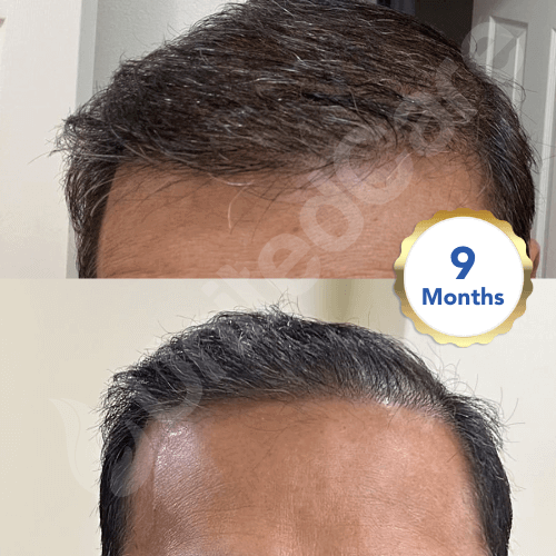 unitedcare hair transplant before after