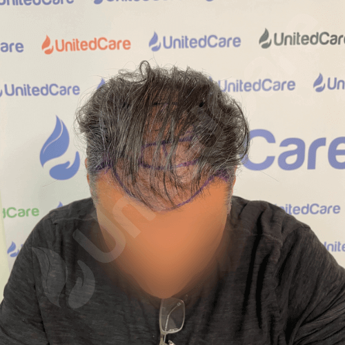 unitedcare hair transplant before after