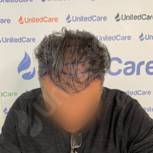 unitedcare clinic Haartransplantationspatient vor der Operation