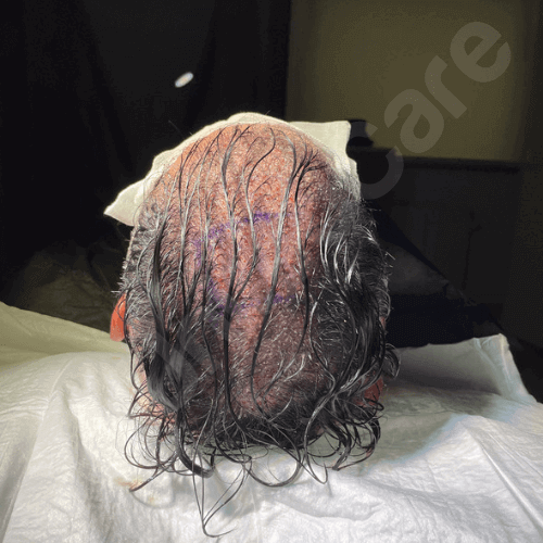 Haartransplantation direkt nach der Operation