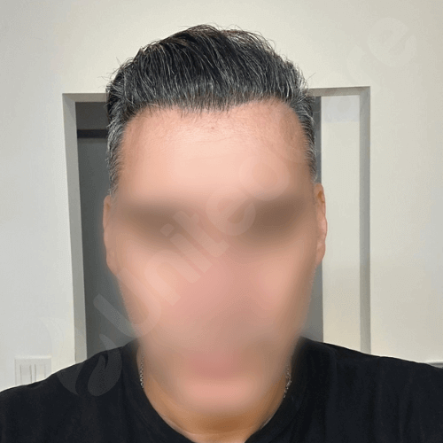 unitedcare hair transplant before after