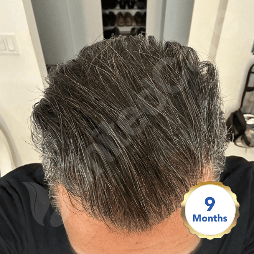 unitedcare hair transplant before after