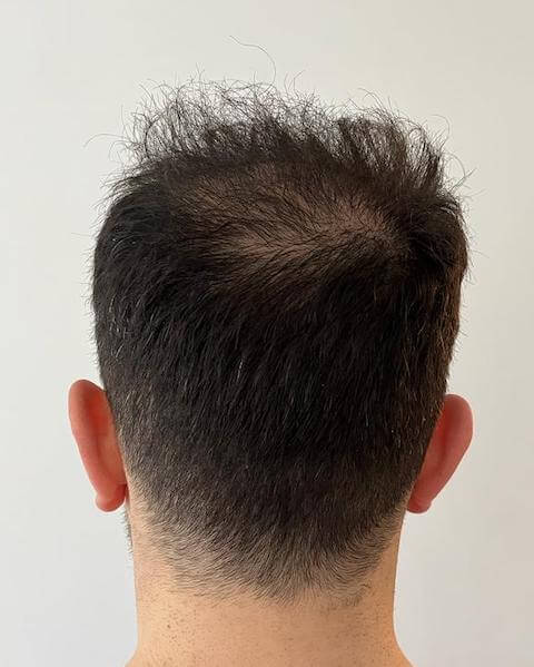 Donor area 5 months after the hair transplant