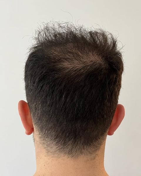 Der Spenderbereich 1 Woche nach der Haartransplantation. Keine Überernte.