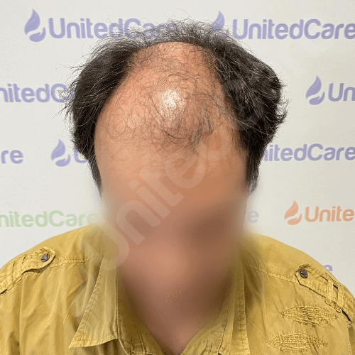 hair transplant before