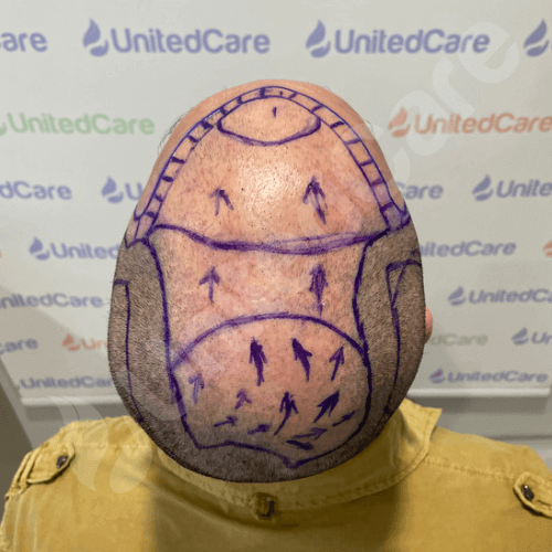 hair transplant scalp with surgical plan in place