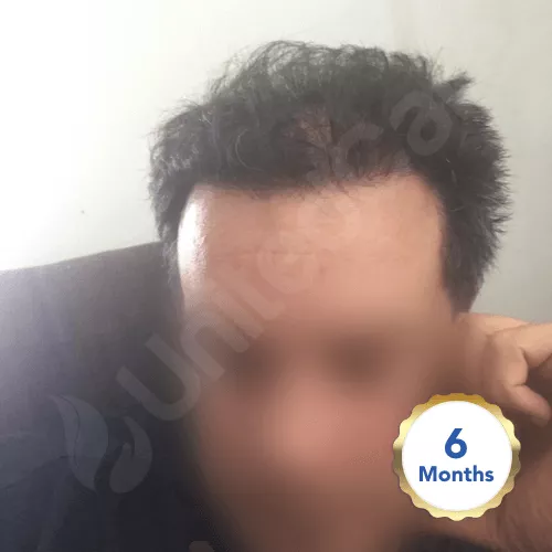 hair transplant after 6 months front