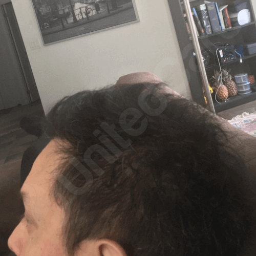 hair transplant after 6 months side