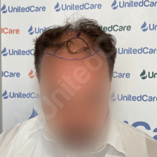 This image has an empty alt attribute; its file name is unitedcare-before-after-hair-transplant-41_03.06.2023.png