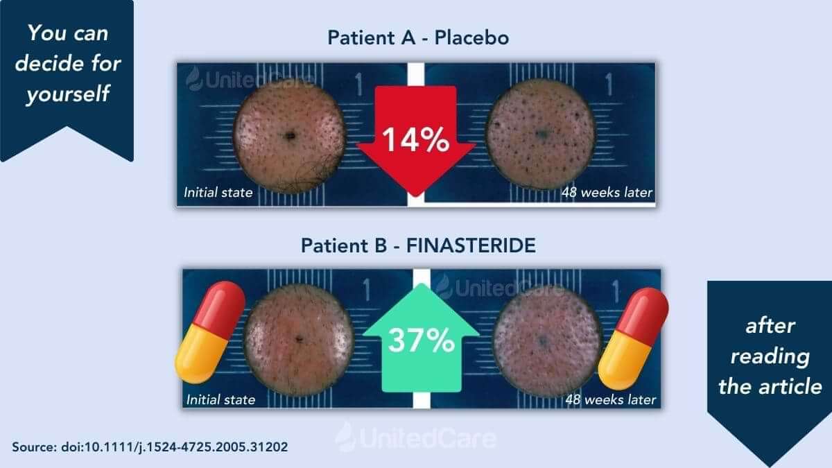 finasteride effectiveness after hair transplant study result