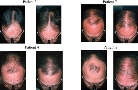 Finasteride study results