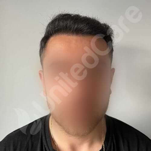 unitedcare clinic hair transplant patient post-op 1 year