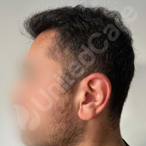 unitedcare clinic hair transplant patient post-op 1 year