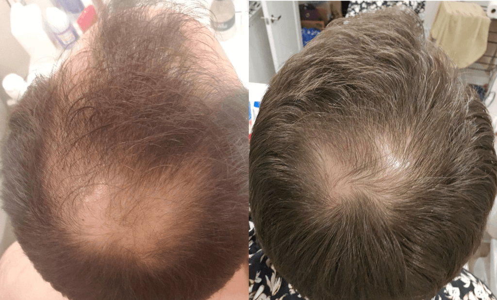 13 months result of Minoxidil