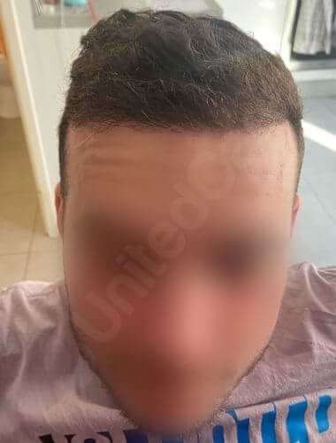 unitedcare hair transplant 6 month result