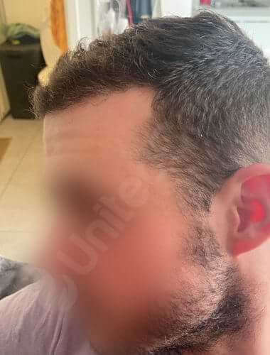 unitedcare hair transplant 6 month result