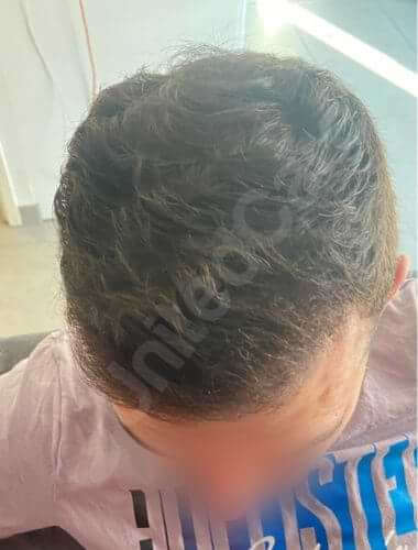 unitedcare hair transplant 6 month result