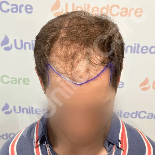 fue surgery with hair transplant plan - hairline