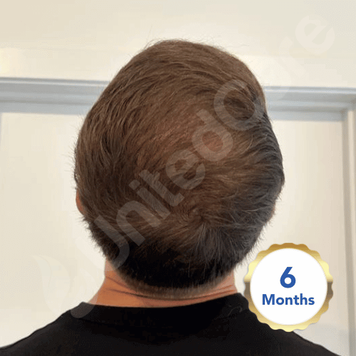 6 month fue surgery result 1