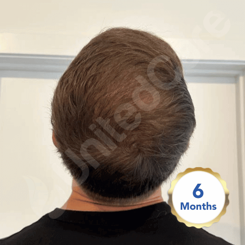 fue surgery turkey 6 month result - crown