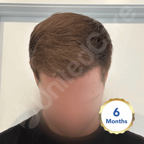 6 month fue surgery result 3