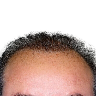 Artas Hair Transplant Robot Before