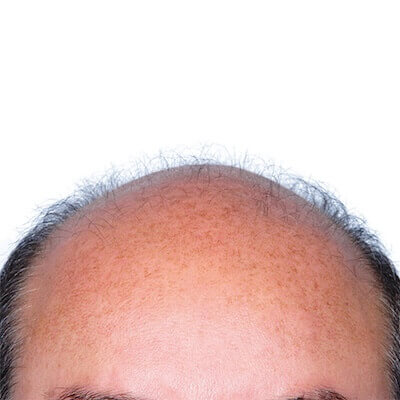 Artas Hair Transplant Robot After