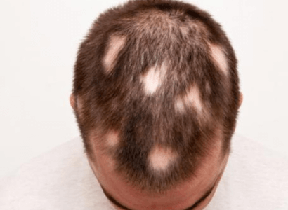alopecia-areata-causing-bald-spots