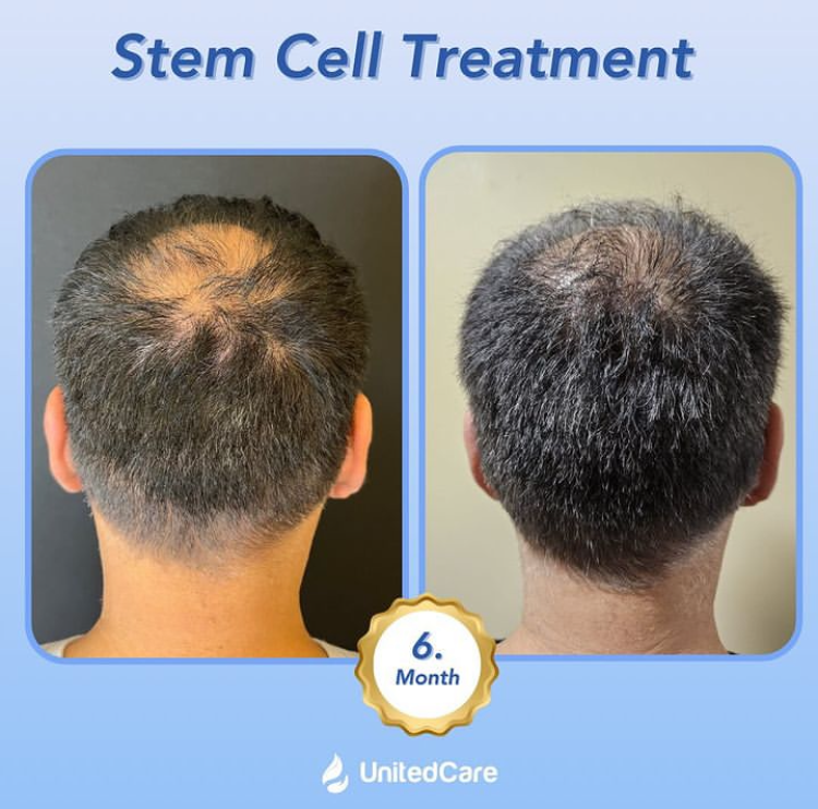 stem cell hair transplant patient