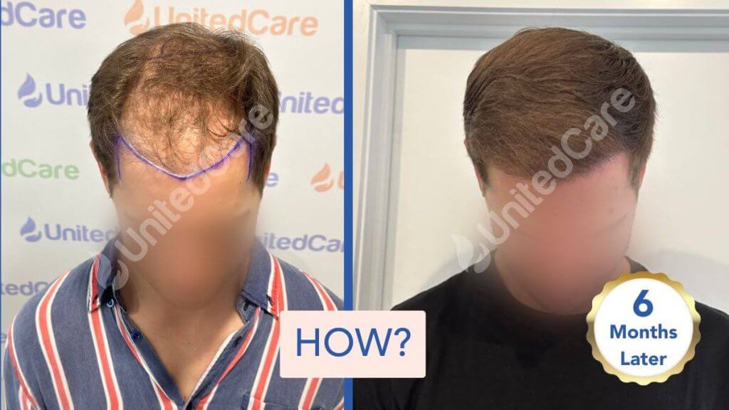 unitedcare clinic hair loss solution before after