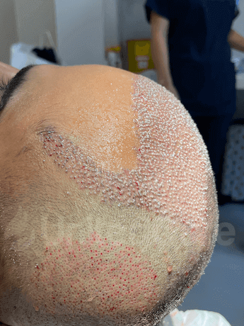 Right after the hair transplant scalp, donor, and recipient areas.